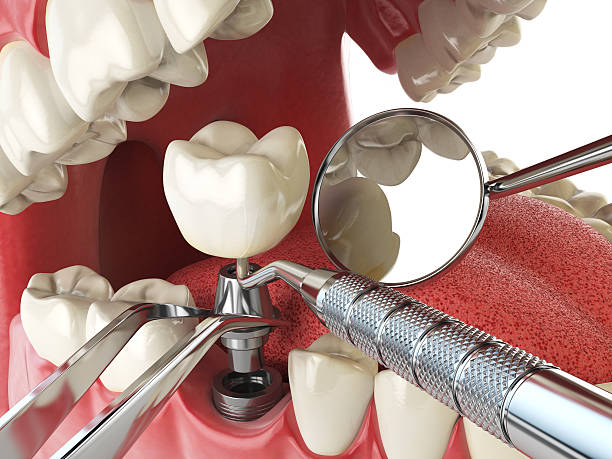 Best Emergency Root Canal Treatment in Royal Palm Beach, FL